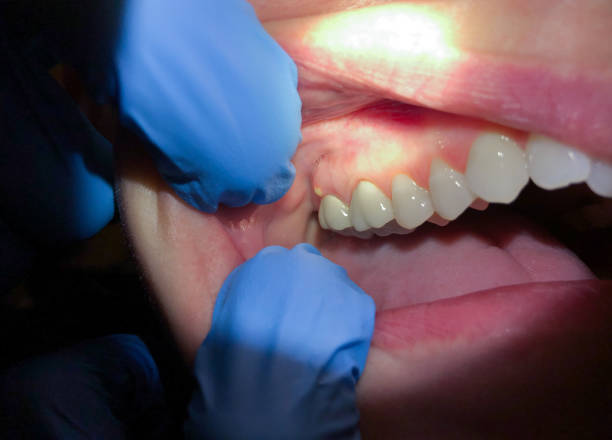 Best Dentist for Tooth Abscess  in Five Corners, WA